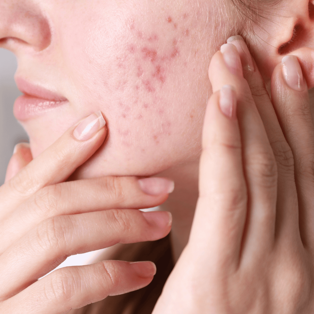 Acné hormonale ou de l’adulte : nos réponses avec le sérum anti-imperfections