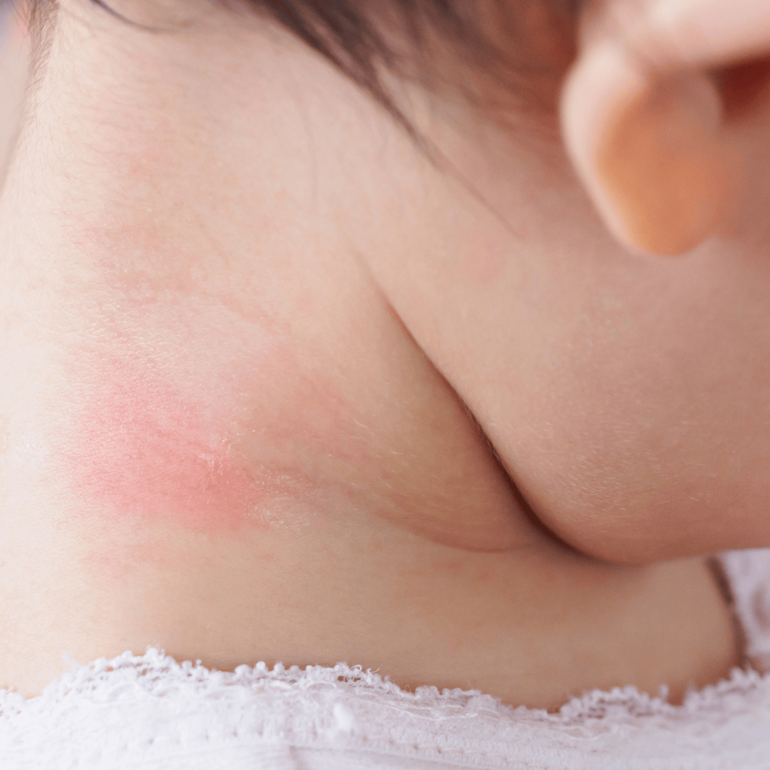 Eczéma chez l’enfant : que faire ? Solutions douces et soins naturels adaptés