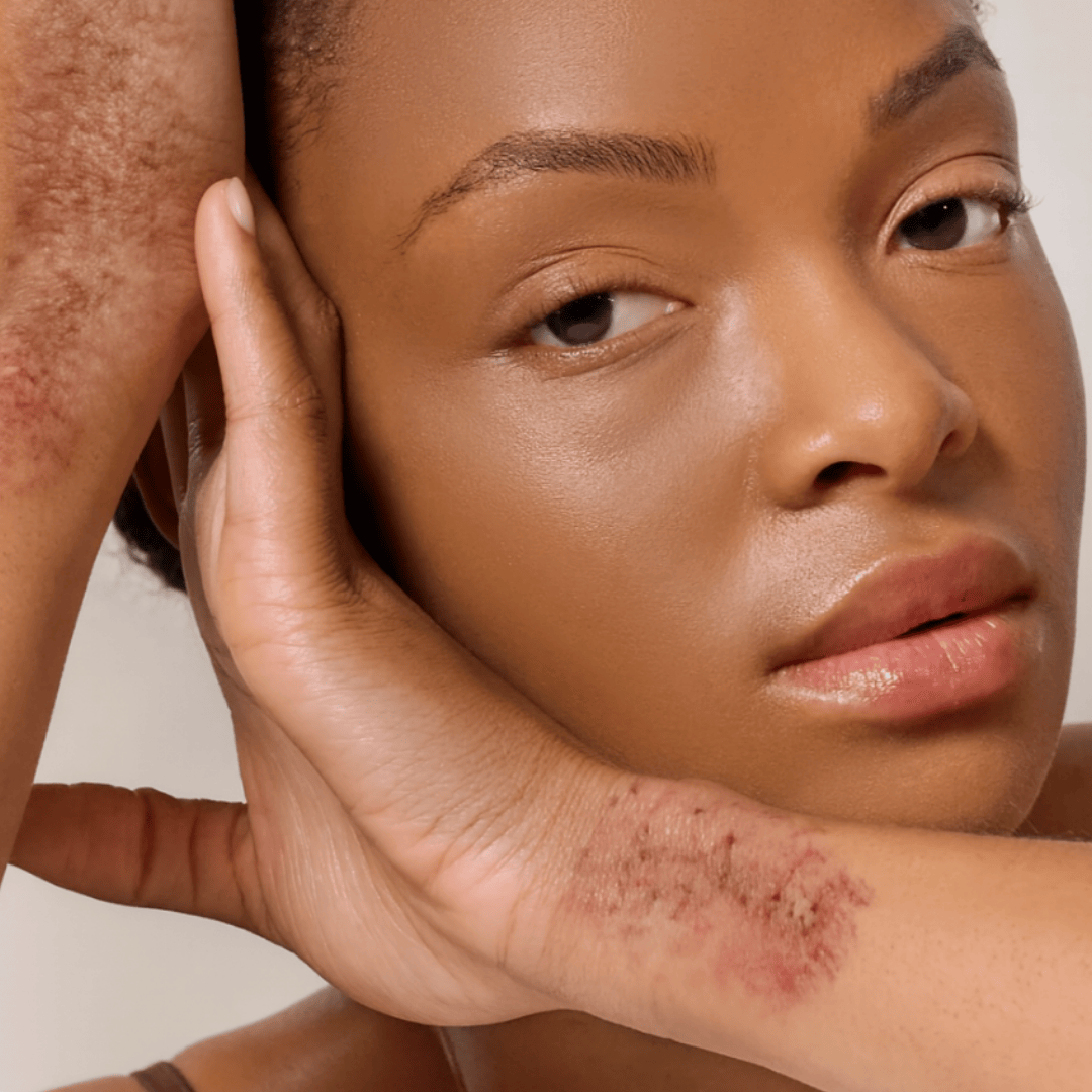 : Peau rouge et irritée due à l’eczéma, une maladie non contagieuse pouvant être apaisée avec des soins naturels.